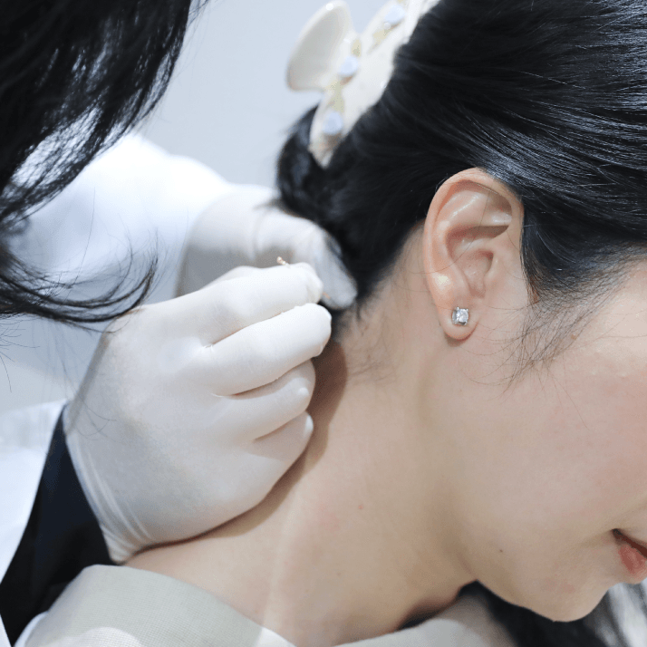 การฝังเข็มตะวันตก หรือ Dry Needling