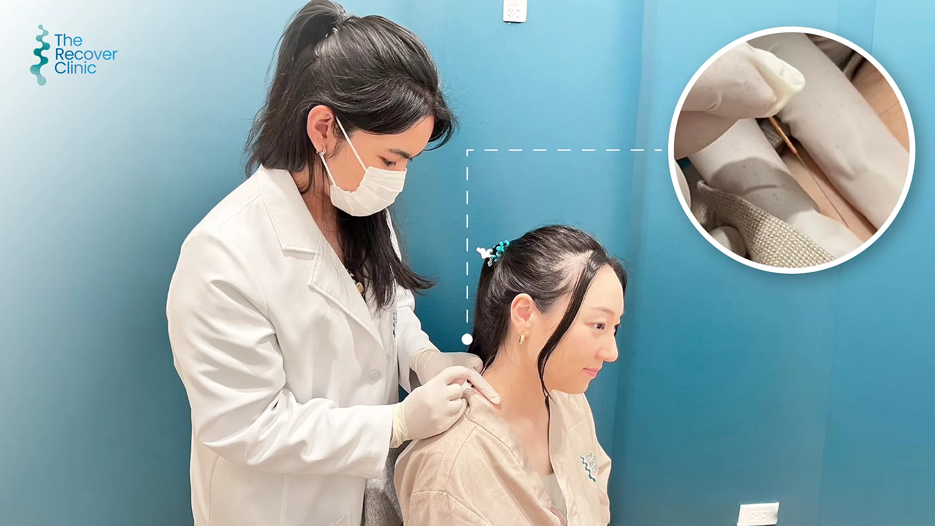 ฝังเข็มตะวันตก, การฝังเข็มตะวันตก, Dry needling