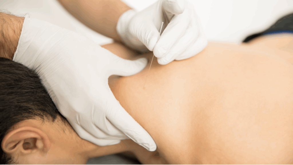 ฝังเข็มตะวันตก (Dry Needling) ช่วยจัดการจุดกดเจ็บอย่างไร