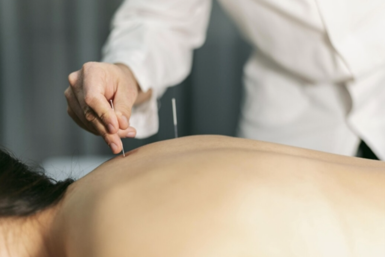 กระบวนการทำงานของ Dry Needling 