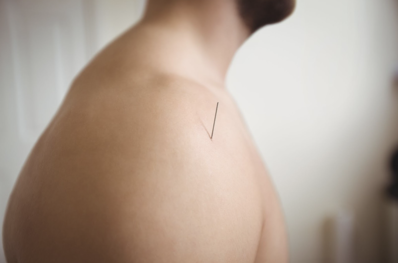 ฝังเข็มแบบ Dry Needling แตกต่างกับ การฝังเข็มแบบจีน